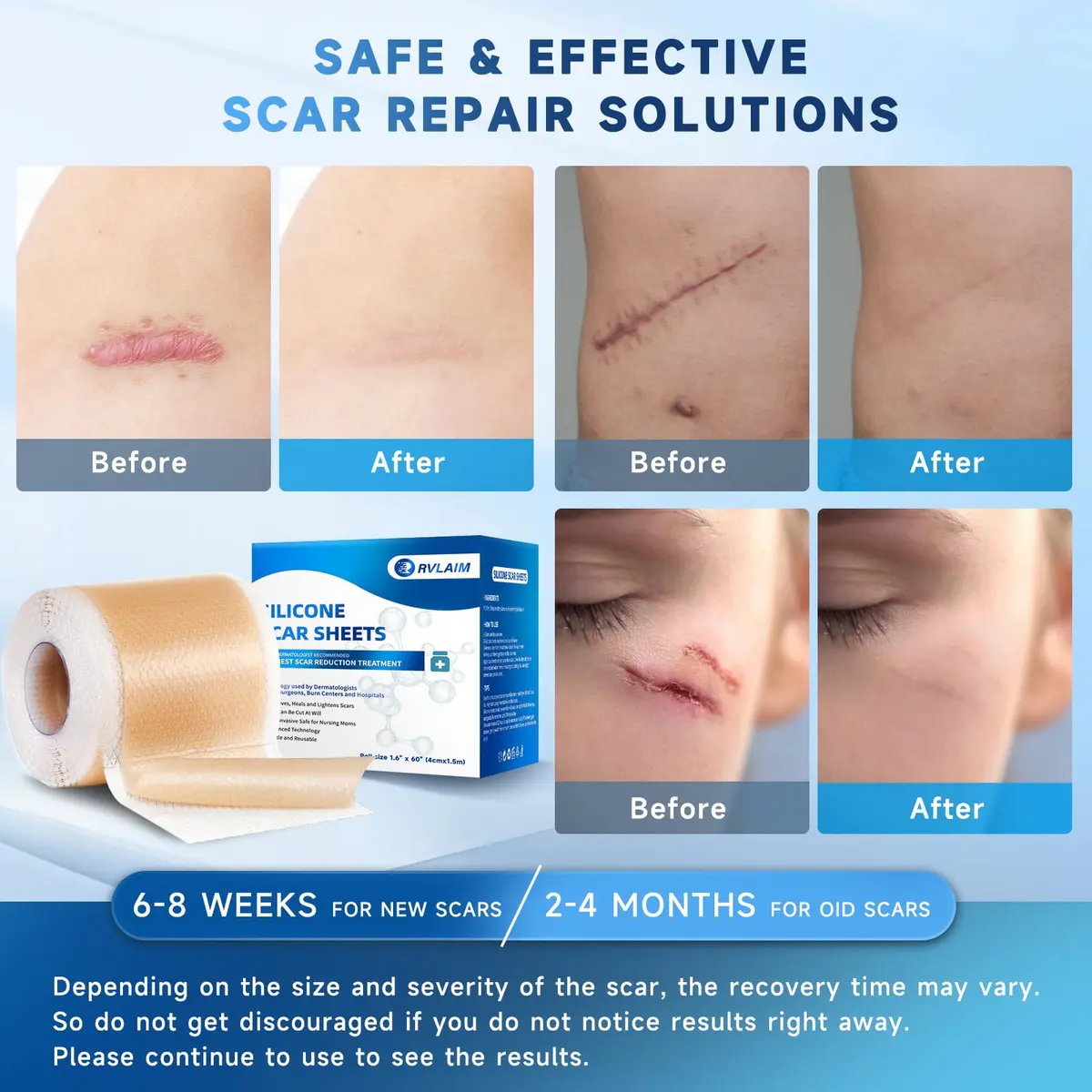 Rvlaim Silicone Scar Sheets, Silicone Scar Tape 1.5M | Clinically Proven Scar Treatment for All Skin Types - view 4