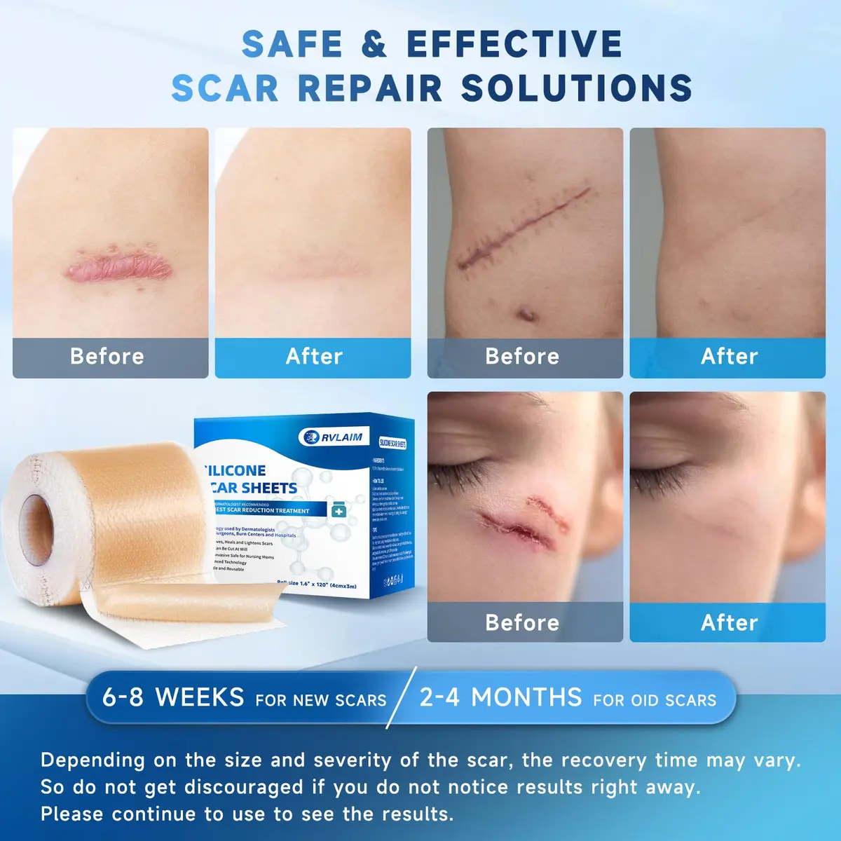 Rvlaim Silicone Scar Sheets for Surgical & Burn Scars, 3M, 1.6” x 120” Roll | Medical-Grade, Reusable & Hypoallergenic - view 4