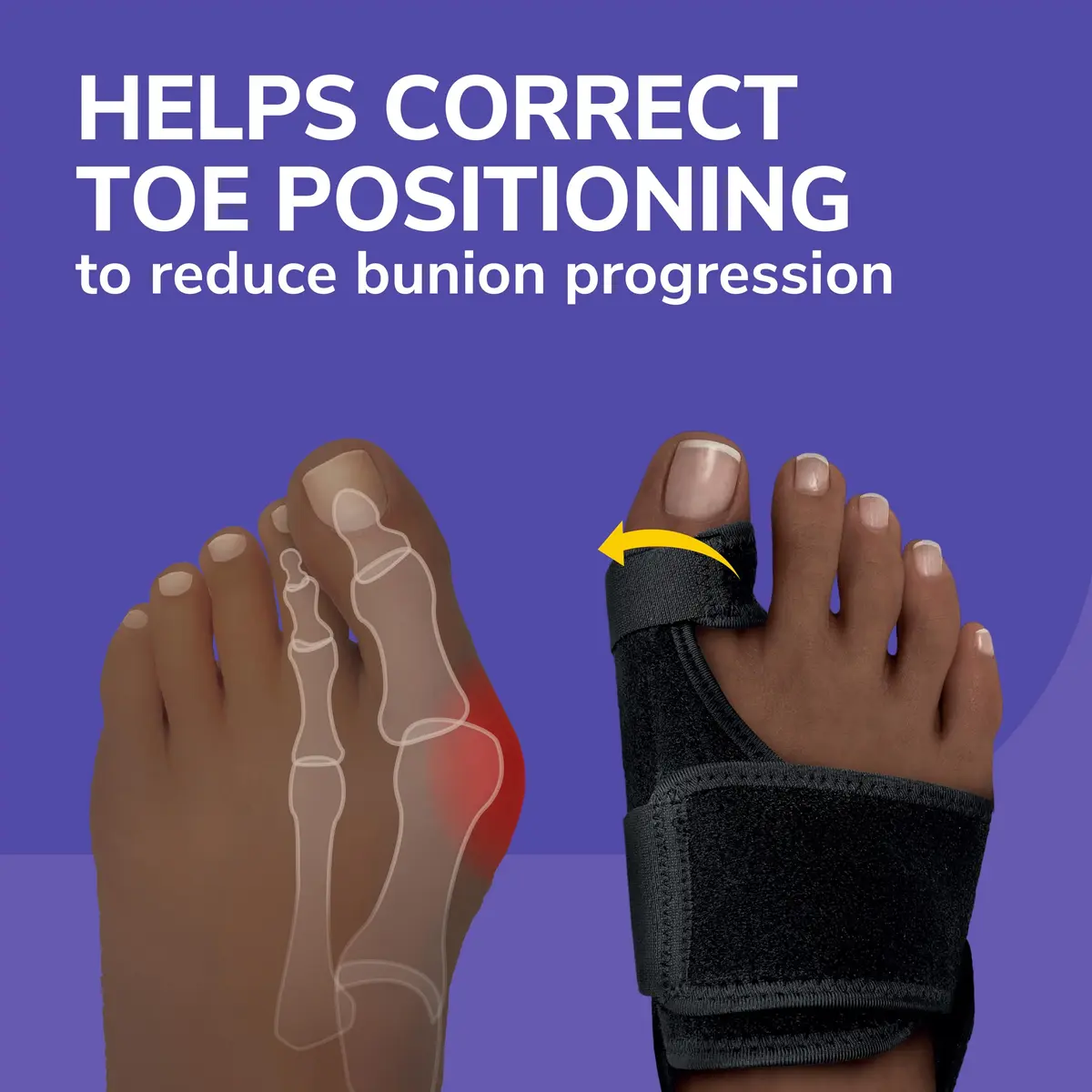 Dr. Scholl's Bunion Relief & Toe Corrector | Night Support for Bunion Pain Relief - view 2