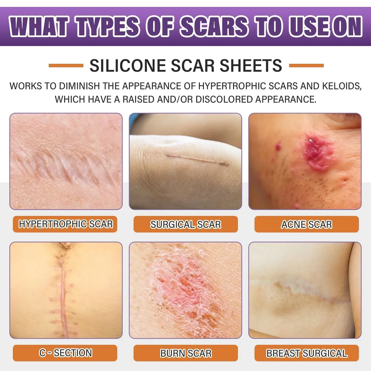 PSECICI Silicone Scar Sheets Medical Grade Tape for Old & New Scars 3M (1.6" x 120") | Advanced Scar Treatment - view 2