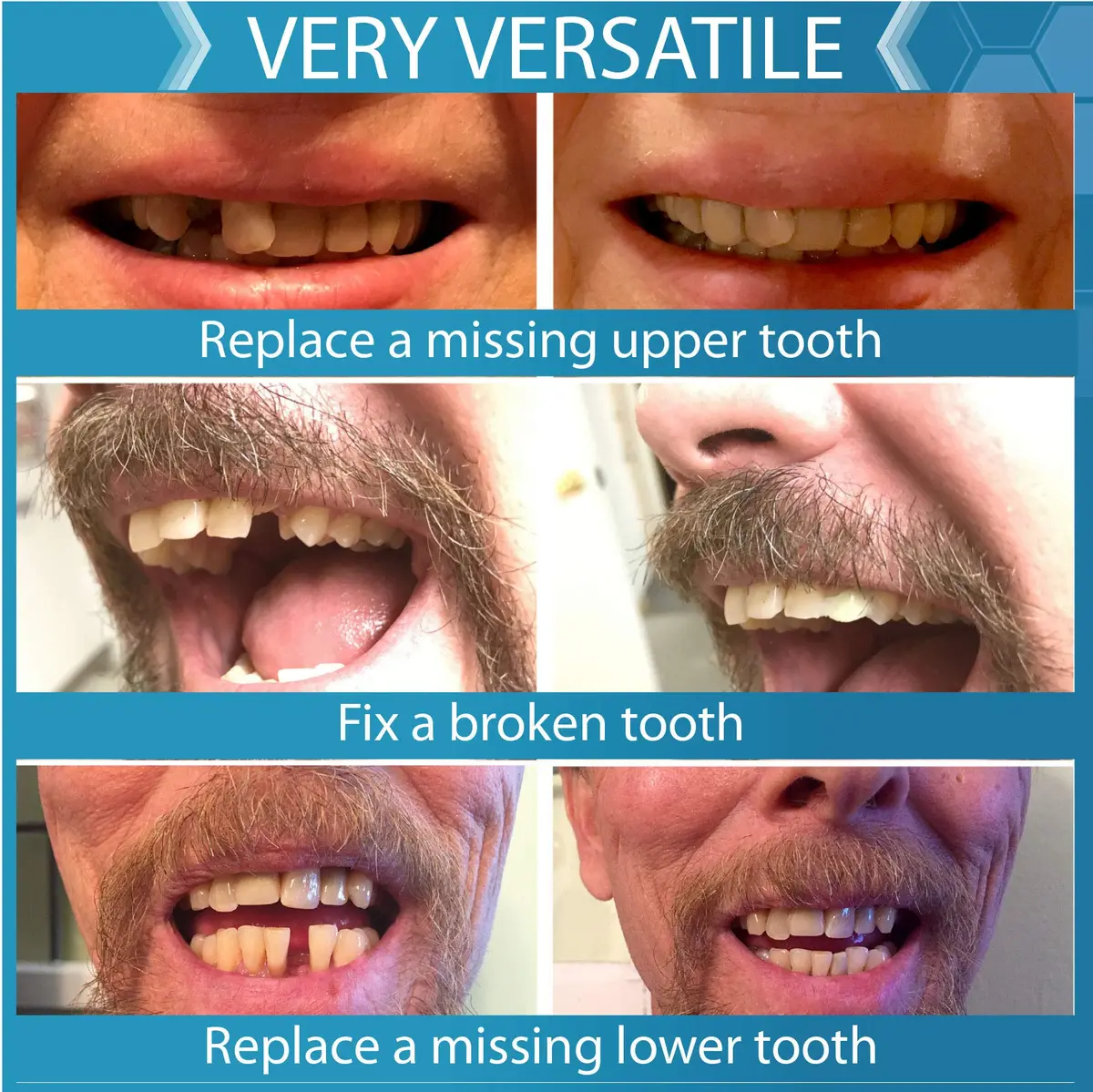 Instant Smile Complete Your Smile Temporary Tooth Replacement Kit - Replace a Missing Tooth in Minutes - Patented (Pack of 2) - view 5