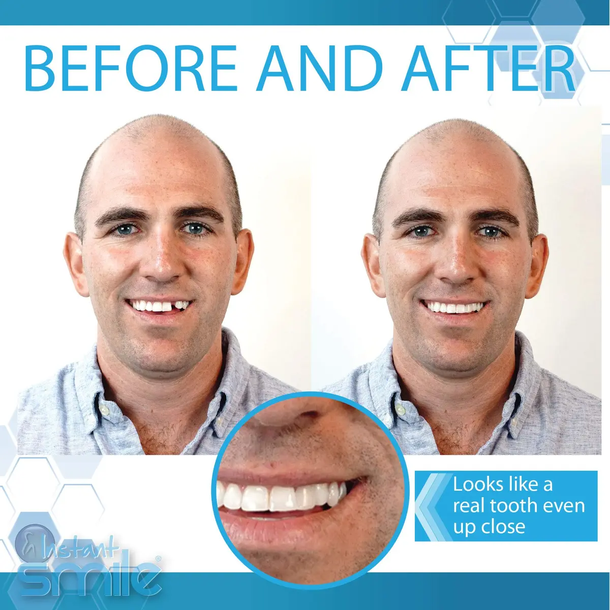 Instant Smile Complete Your Smile Temporary Tooth Replacement Kit - Replace a Missing Tooth in Minutes - Patented (Pack of 2) - view 3